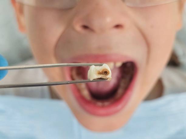 Best Emergency Root Canal Treatment in Kirbyville, TX